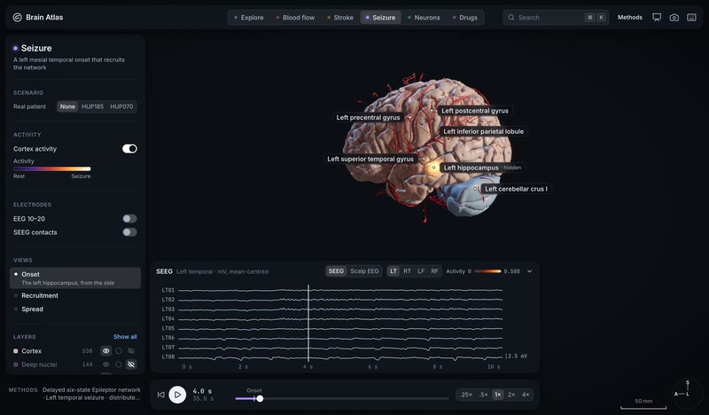 The hidden onset zone glows through the temporal lobe.