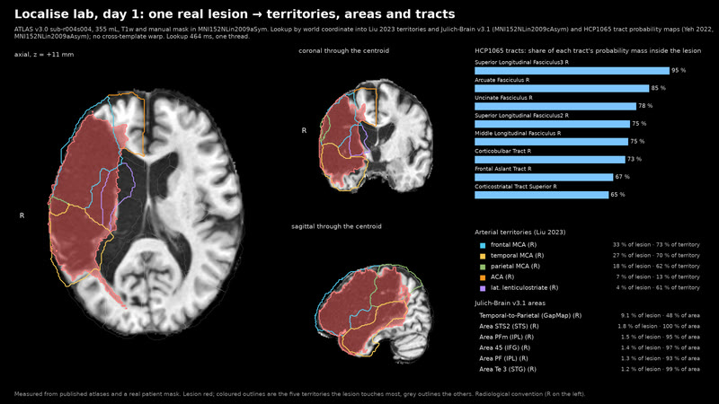 One real lesion, read against the atlases.