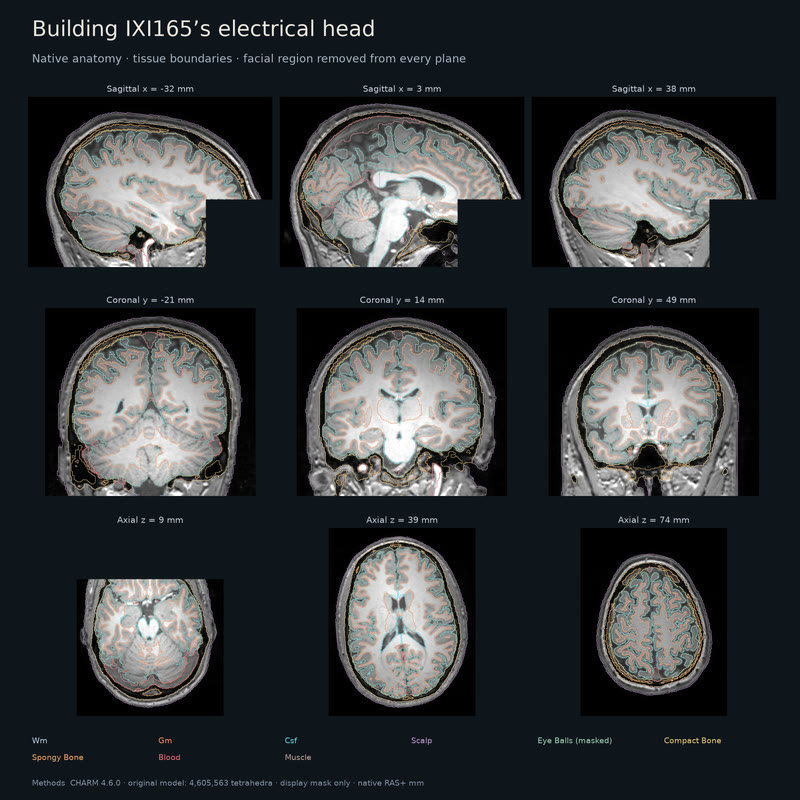 IXI165, from MRI to an electrical head.