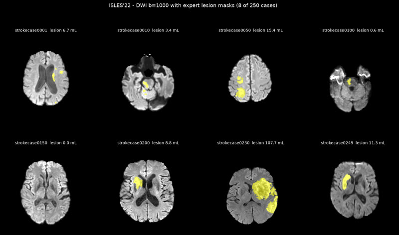 ISLES'22: 250 cases with expert lesion masks.