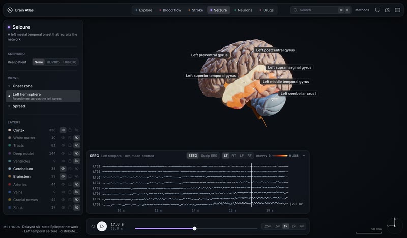 A seizure lights BigBrain's own cortex, live in the app.
