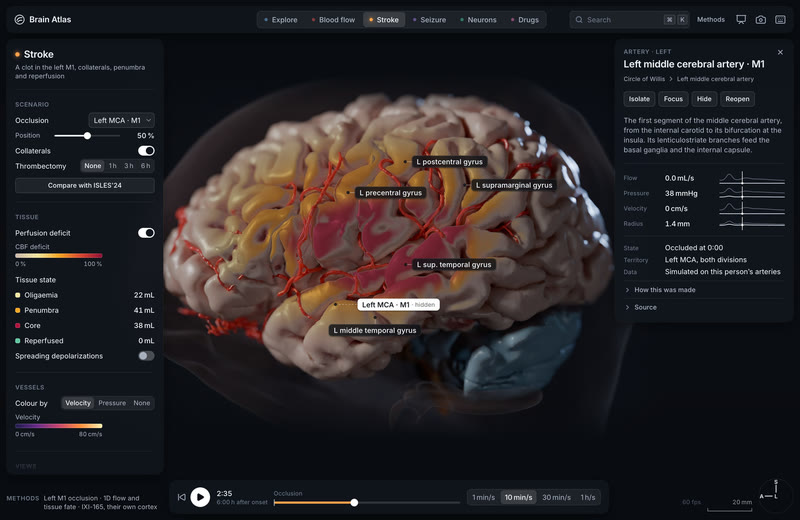 Stroke, 2 h 35 after the clot.