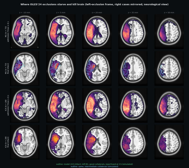 Where real strokes starve and kill brain.