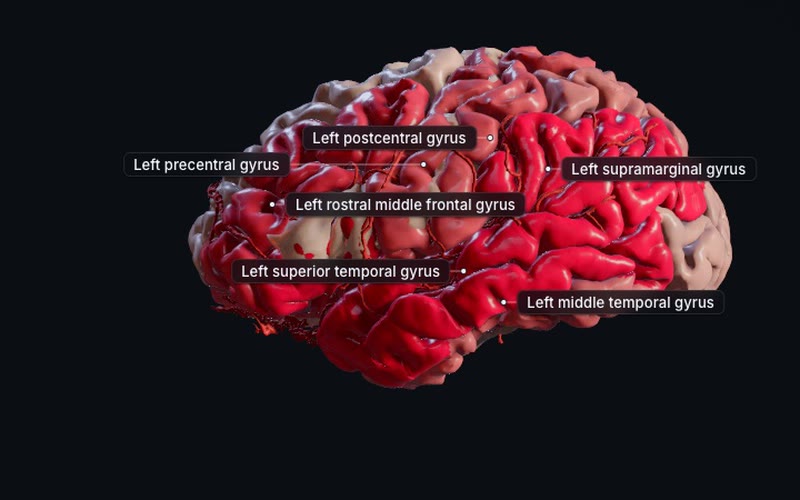A brain seen from the left in the Stroke scene, 24 hours after a left middle cerebral artery clot: most of the left hemisphere's gyri tinted deep red for core, a few in pale pink, with six gyri labelled.